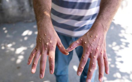 Maymun çiçeği virüsü Avrupa'ya sıçradı: İsveç'te ilk vaka tespit edildi