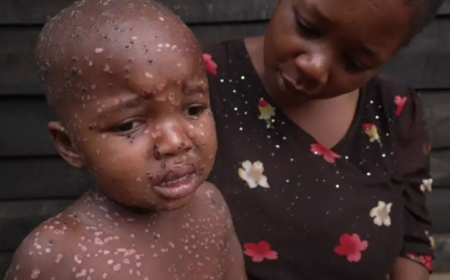 Maymun çiçeği vakalarının çoğu çocuk