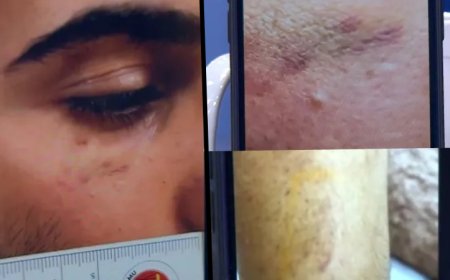 Narin Güran’ın abisinin kolundaki ısırık ve yüzündeki morluk izlerinin fotoğrafları ortaya çıktı